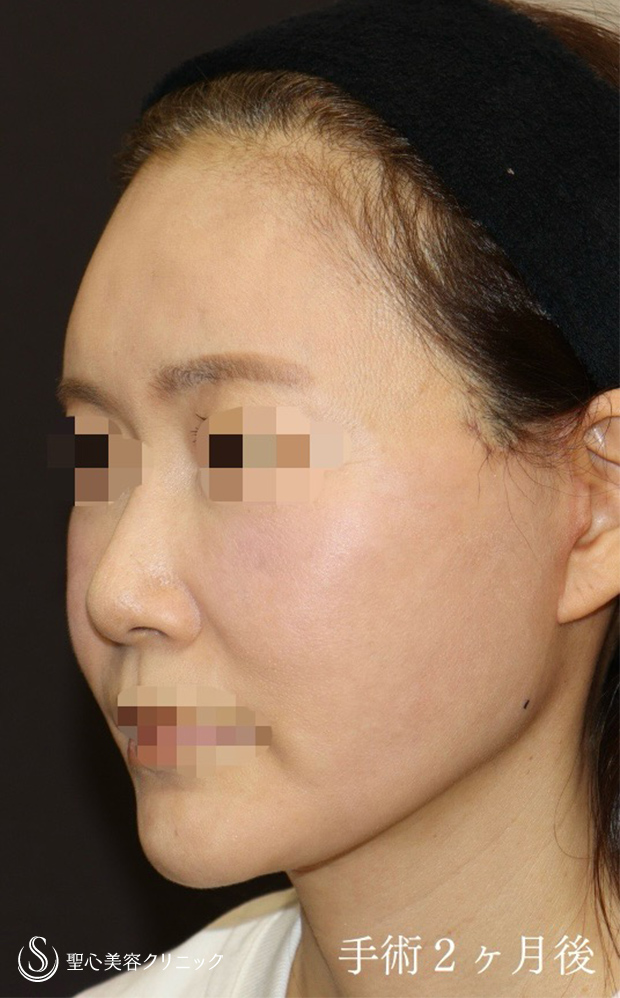 【50代女性・フェイスラインもあご下もオデコも若々しく】フェイスリフト＋前額リフト（2ヶ月後） After 