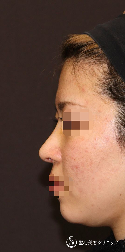 【20代女性・ACR、鼻筋を整えて美人に】他院修正＋鼻中隔延長（肋軟骨）＋ 鼻中隔延長（肋軟骨）＋オーダーメイドプロテーゼ（1週間後） After 