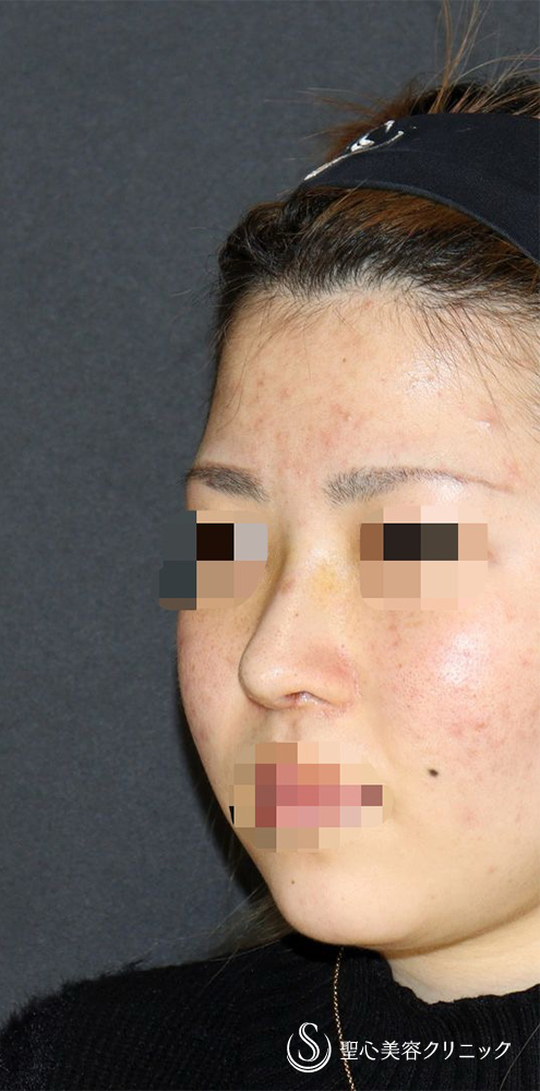 【20代女性・ACR、鼻筋を整えて美人に】他院修正＋鼻中隔延長（肋軟骨）＋ 鼻中隔延長（肋軟骨）＋オーダーメイドプロテーゼ（1週間後） After 