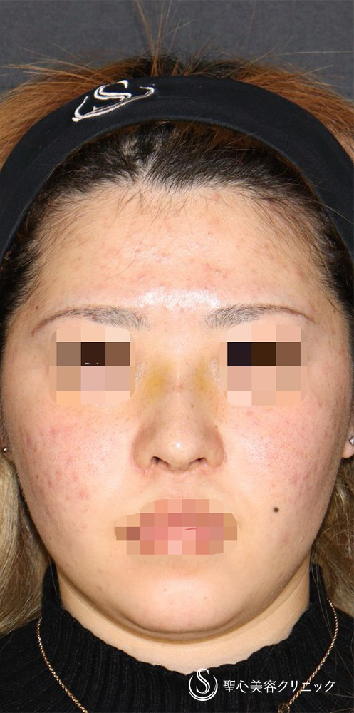 【20代女性・ACR、鼻筋を整えて美人に】他院修正＋鼻中隔延長（肋軟骨）＋ 鼻中隔延長（肋軟骨）＋オーダーメイドプロテーゼ（1週間後） After 