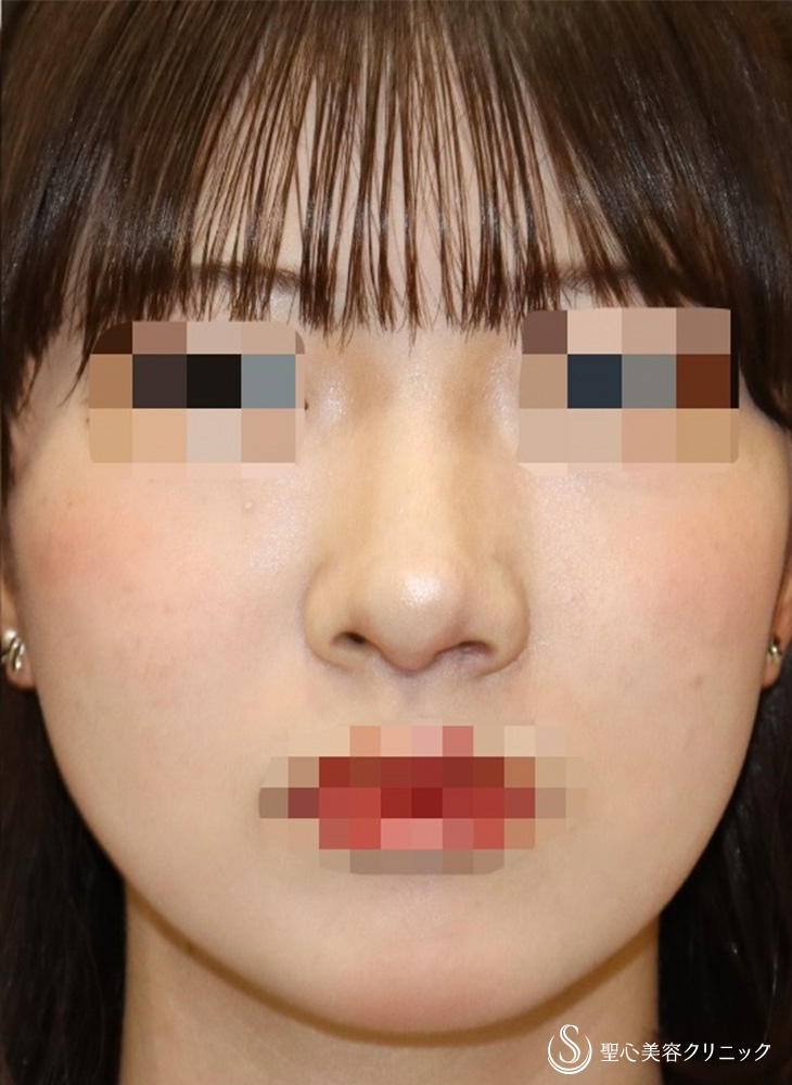 【10代女性・他院修正で鼻の左右差を目立たなく】他院修正＋鼻翼縮小＋鼻翼挙上術（2ヶ月後） After 