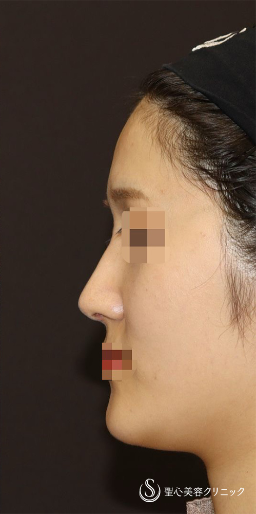 【20代女性・美鼻形成でお顔全体をも美人に】鼻中隔延長（肋軟骨）＋鼻尖形成＋鼻背軟骨移植＋鼻根部ダイス移植（肋軟骨）（2ヶ月後） After 