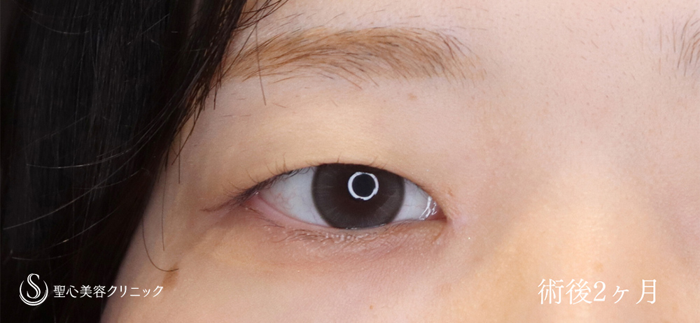 【20代女性・目頭切開で目を切長な印象に】目頭切開（1週間後～2ヶ月後） After 