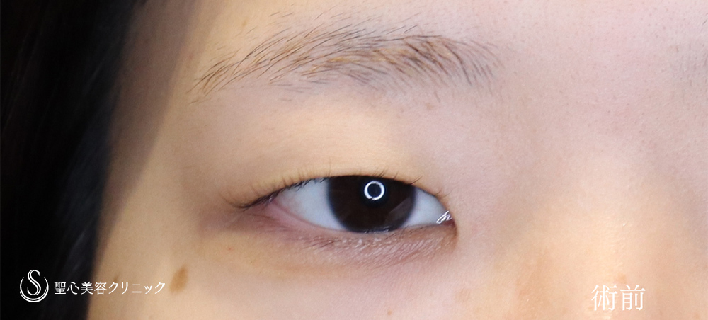 【20代女性・目頭切開で目を切長な印象に】目頭切開（1週間後～2ヶ月後） Before 