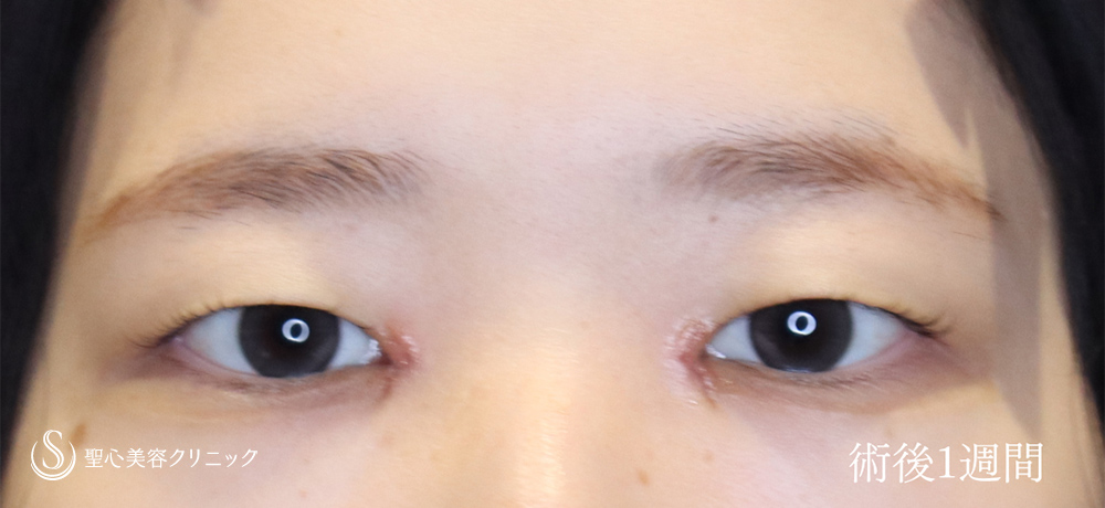 【20代女性・目頭切開で目を切長な印象に】目頭切開（1週間後～2ヶ月後） After 