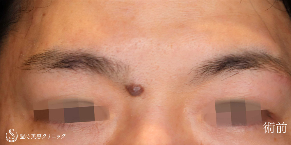 【30代男性・眉間のホクロを切除】ホクロ除去（切除法）（1週間後） Before 