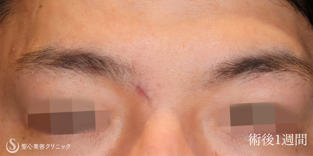【30代男性・眉間のホクロを切除】ホクロ除去（切除法）（1週間後） After 