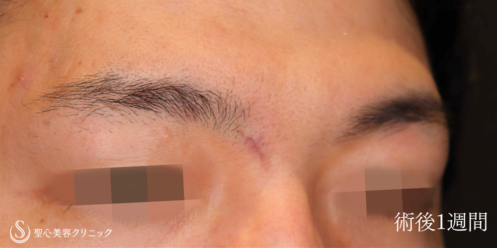 【30代男性・眉間のホクロを切除】ホクロ除去（切除法）（1週間後） After 