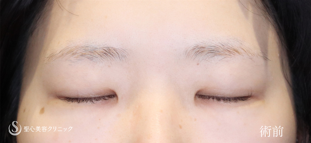 【20代女性・目頭切開で目を切長な印象に】目頭切開（1週間後～2ヶ月後） Before 