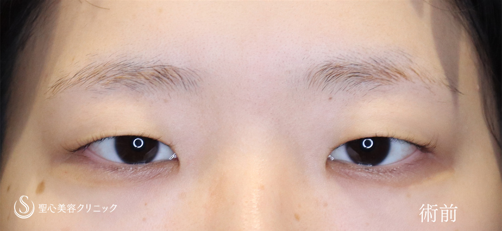 【20代女性・目頭切開で目を切長な印象に】目頭切開（1週間後～2ヶ月後） Before 