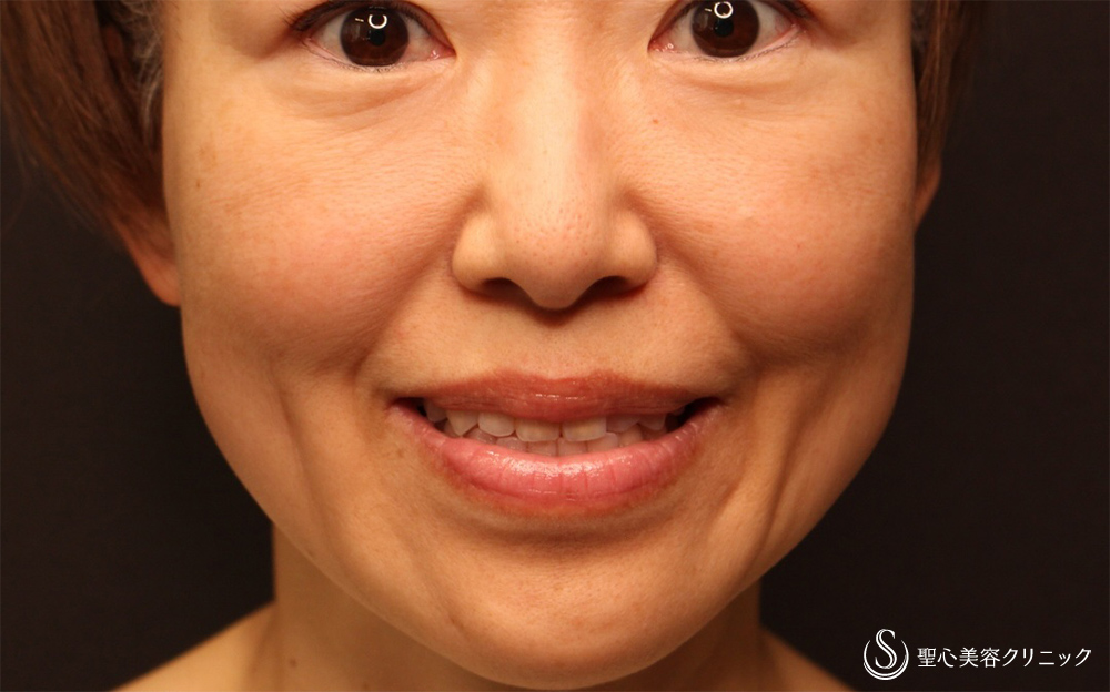 【40代女性・笑顔を綺麗に】プレミアムPRP皮膚再生療法（ほうれい線＋マリオネットライン＋頬）（3ヶ月後） Before 