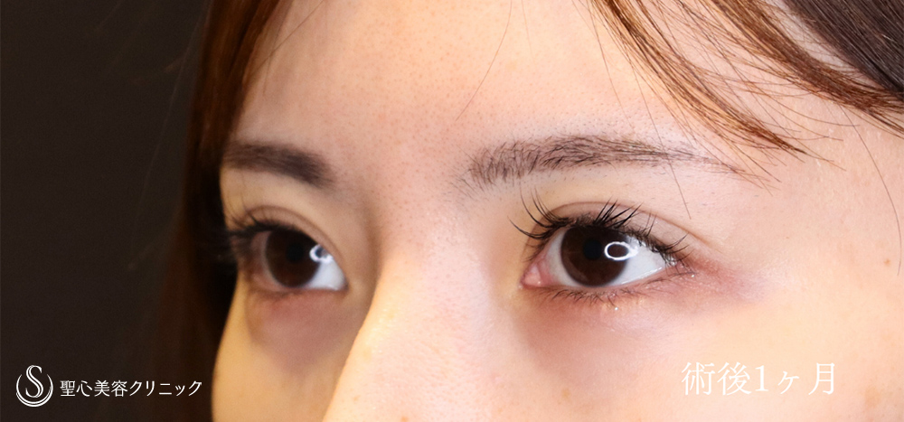 【20代女性・埋没法でわずかな左右差を整える】マイクロメソッド+α（二重埋没法）（1ヶ月後～1ヶ月半後） After 