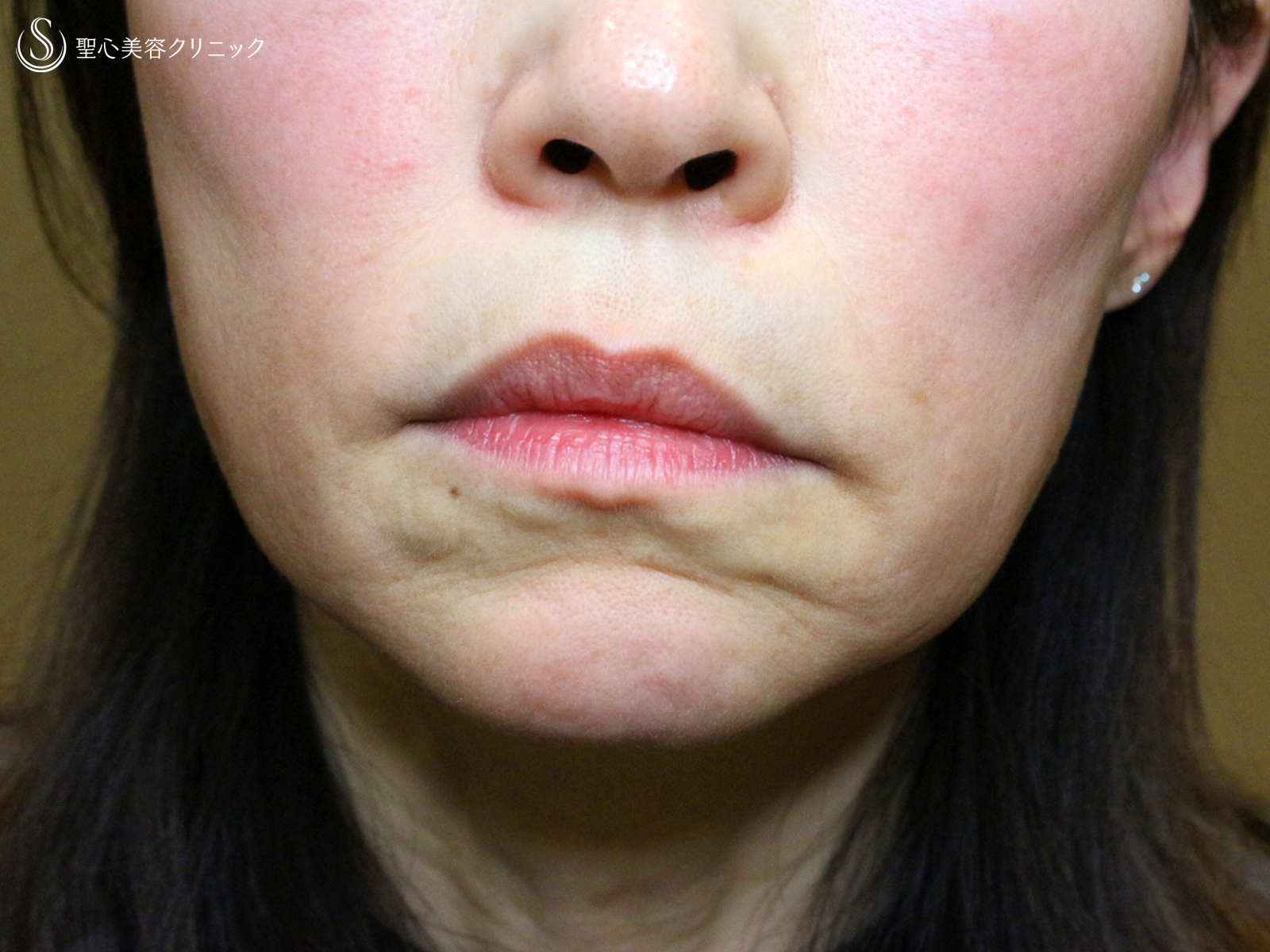 【60代女性・年齢を感じさせる「アゴの横じわ」】プレミアムPRP皮膚再生療法（10ヶ月後） Before 