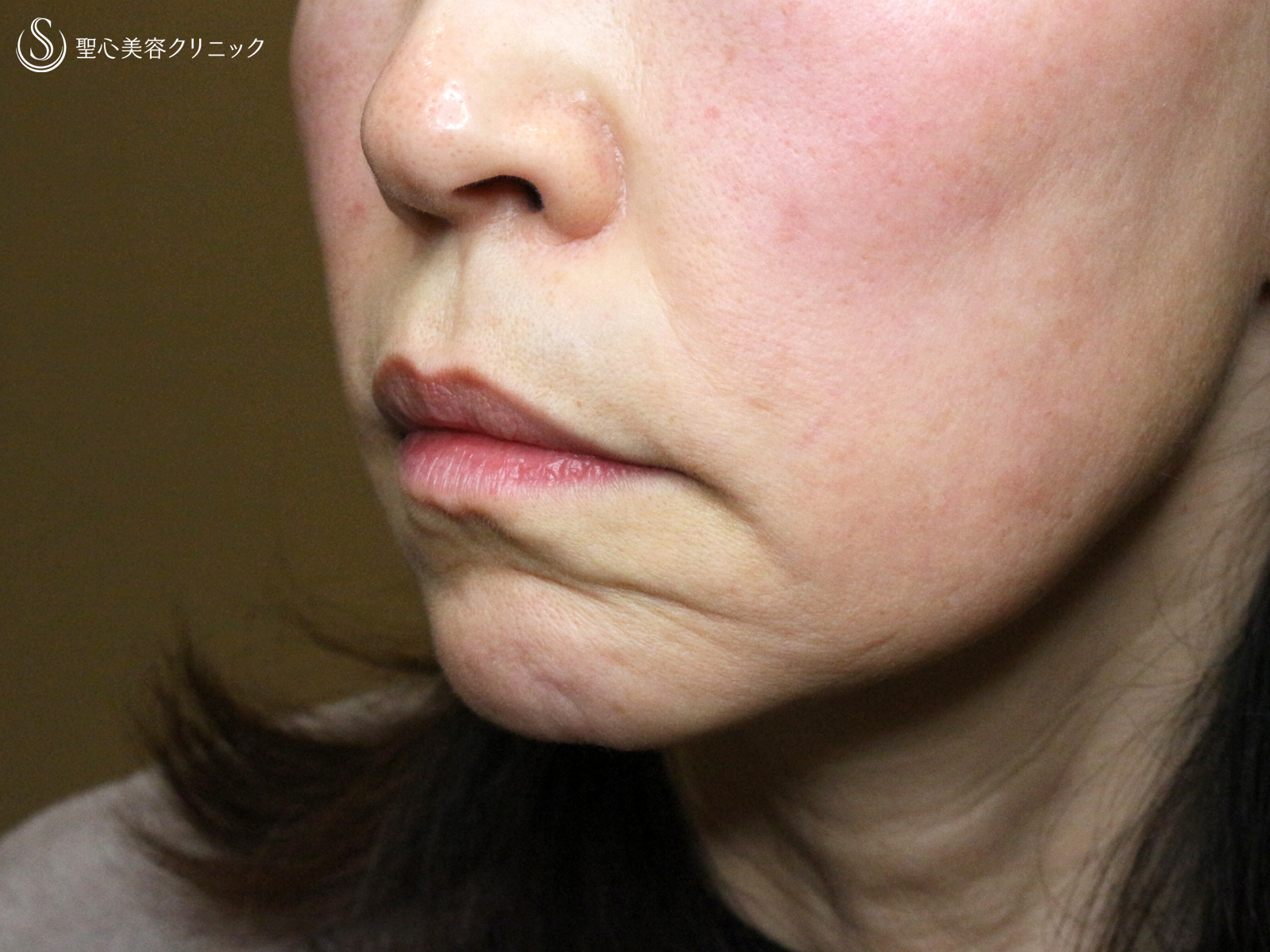 【60代女性・年齢を感じさせる「アゴの横じわ」】プレミアムPRP皮膚再生療法（10ヶ月後） Before 
