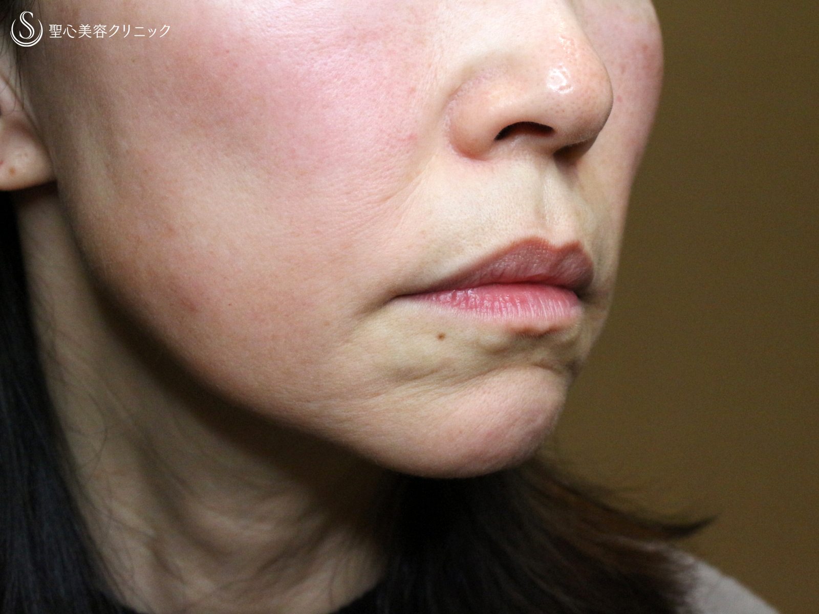 【60代女性・年齢を感じさせる「アゴの横じわ」】プレミアムPRP皮膚再生療法（10ヶ月後） Before 