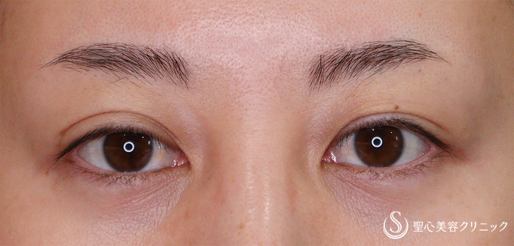 【30代女性・右の二重幅調整】眼瞼下垂（腱膜縫縮法）（1ヶ月後） Before 
