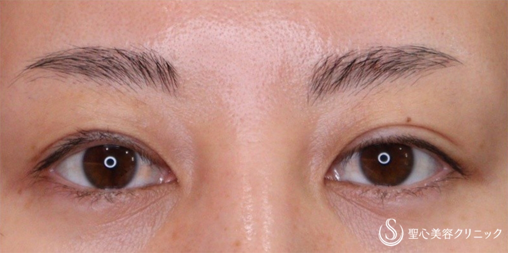 【30代女性・右の二重幅調整】眼瞼下垂（腱膜縫縮法）（1ヶ月後） After 