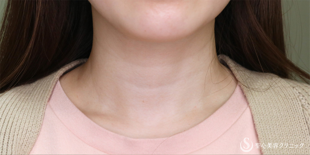 【30代女性・薄い横ジワも改善】プレミアムPRP皮膚再生療法（首）（6ヶ月後） Before 