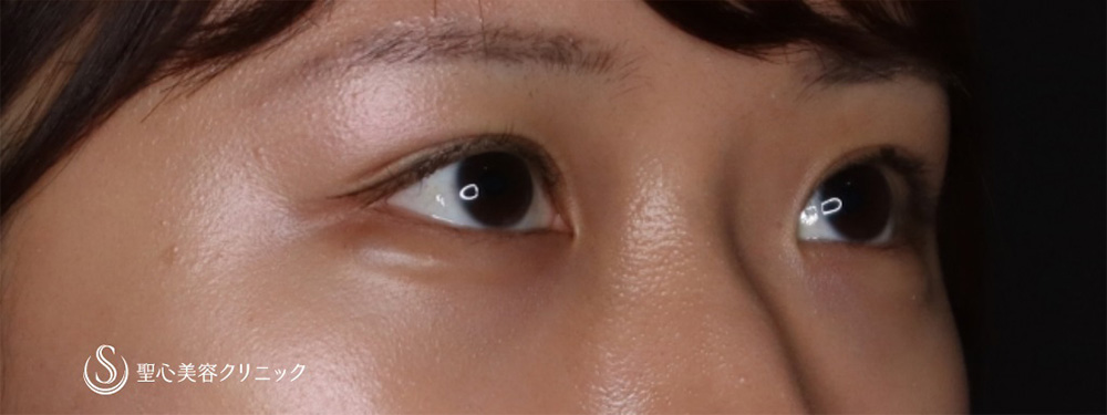 【20代女性・目元を愛らしく】ヒアルロン酸注入（涙袋）（2週間後） After 