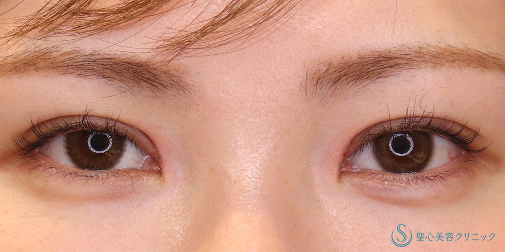 【30代女性・寄り目にさせず目頭側まで二重を入れたい】目上切開（8日後） After 