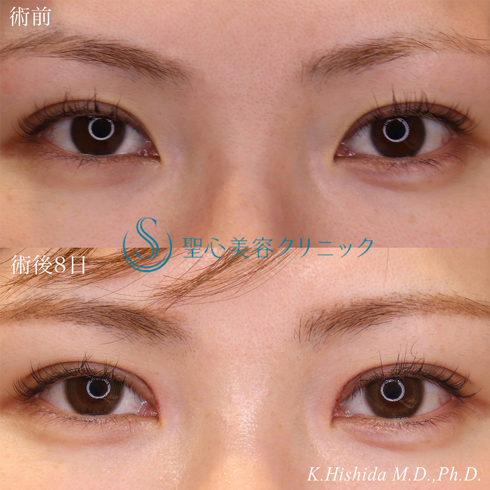 【30代女性・寄り目にさせず目頭側まで二重を入れたい】目上切開（8日後） After 