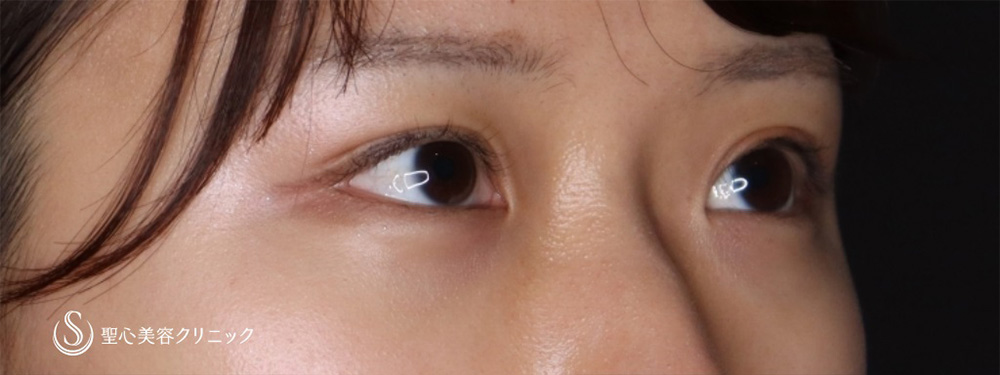 【20代女性・目元を愛らしく】ヒアルロン酸注入（涙袋）（2週間後） Before 