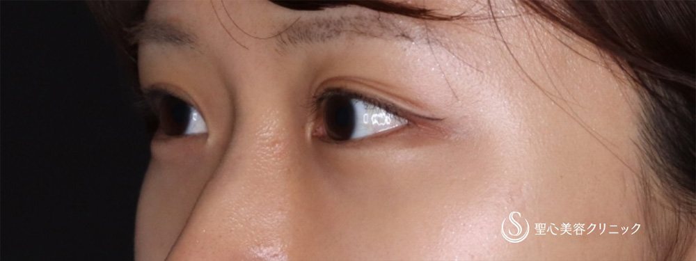 【20代女性・目元を愛らしく】ヒアルロン酸注入（涙袋）（2週間後） Before 