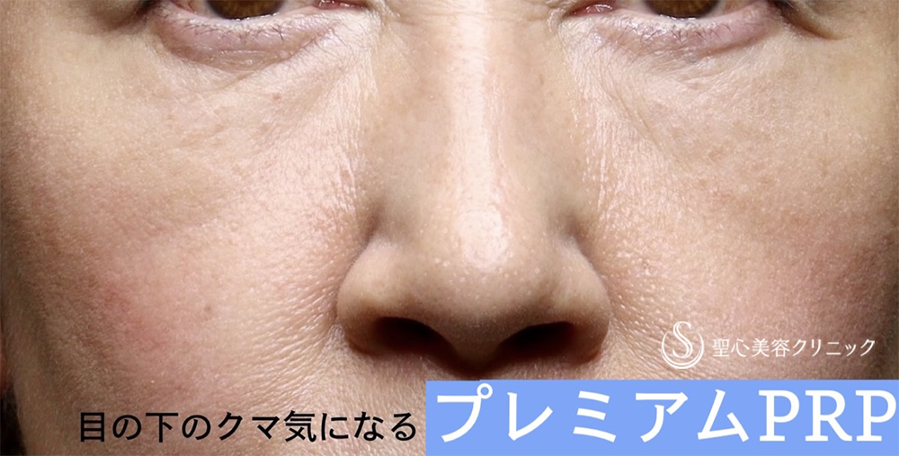 【50代女性・目の下のクマ】プレミアムPRP皮膚再生療法（半年後） After 