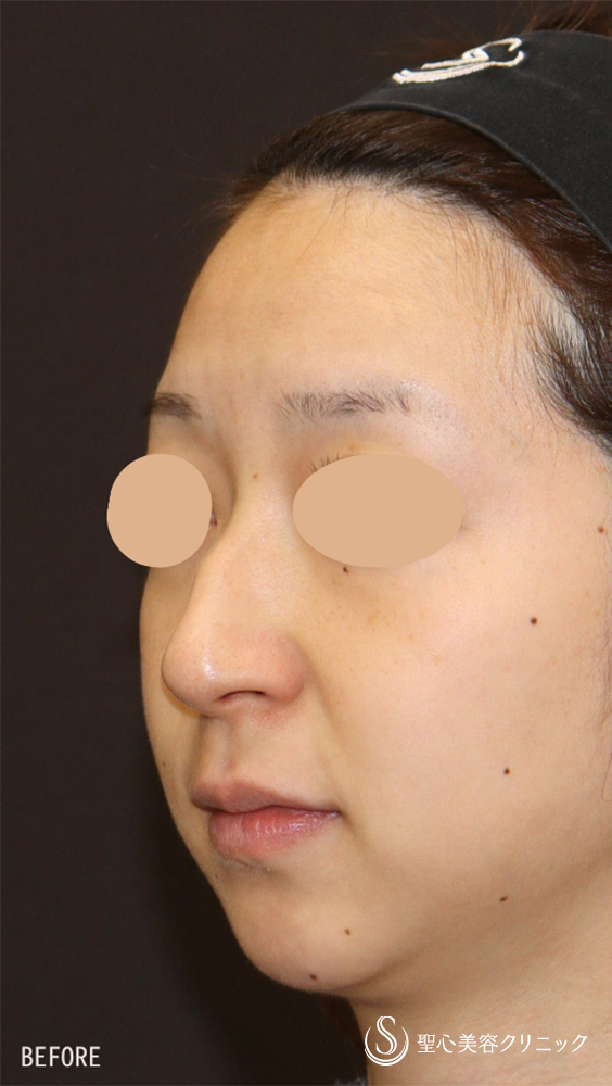 【30代女性・斜鼻＋鷲鼻を修正し鼻全体をスッキリと】鼻骨骨切り（1週間後） Before 
