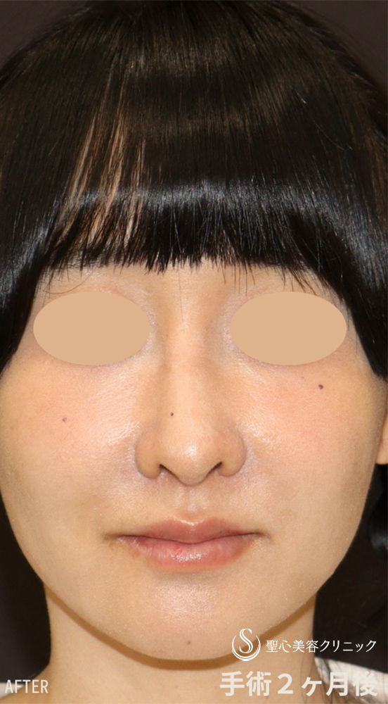 【20代女性・鼻の穴、鼻先、鼻筋を改善して美鼻に】他院修正＋鼻尖縮小＋鼻尖形成（耳介軟骨移植）＋ストラット法（耳介軟骨）＋隆鼻プロテーゼ＋鼻孔縁下降術（2ヶ月後） After 