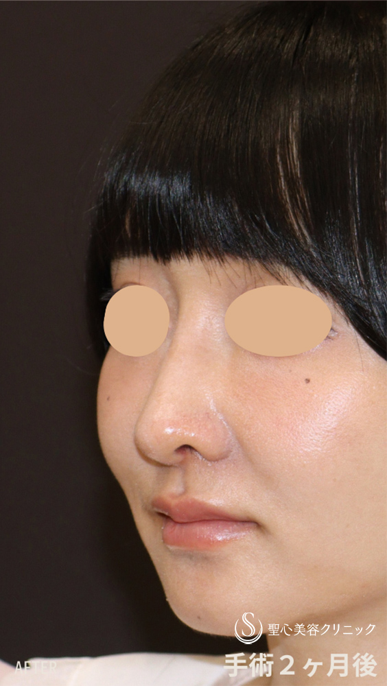 【20代女性・鼻の穴、鼻先、鼻筋を改善して美鼻に】他院修正＋鼻尖縮小＋鼻尖形成（耳介軟骨移植）＋ストラット法（耳介軟骨）＋隆鼻プロテーゼ＋鼻孔縁下降術（2ヶ月後） After 