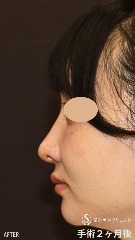 【20代女性・鼻の穴、鼻先、鼻筋を改善して美鼻に】他院修正＋鼻尖縮小＋鼻尖形成（耳介軟骨移植）＋ストラット法（耳介軟骨）＋隆鼻プロテーゼ＋鼻孔縁下降術（2ヶ月後） After 