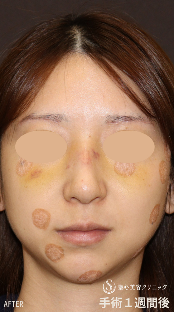 【30代女性・斜鼻＋鷲鼻を修正し鼻全体をスッキリと】鼻骨骨切り（1週間後） After 