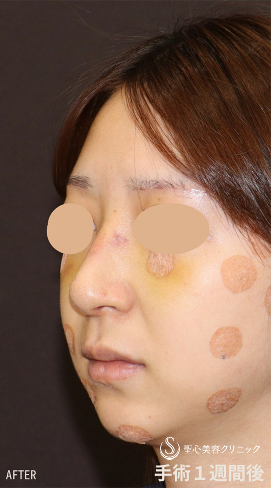 【30代女性・斜鼻＋鷲鼻を修正し鼻全体をスッキリと】鼻骨骨切り（1週間後） After 