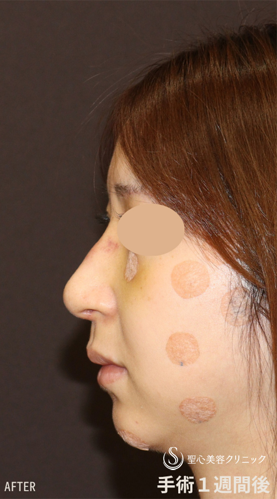【30代女性・斜鼻＋鷲鼻を修正し鼻全体をスッキリと】鼻骨骨切り（1週間後） After 
