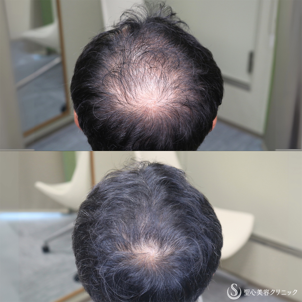 【50代男性・太くハリのある毛髪へ】プレミアムグロースファクター再生療法（12回）＋デュタステリドAV＋ノキシジル（1年後） After 名古屋院・AGA治療・薄毛治療