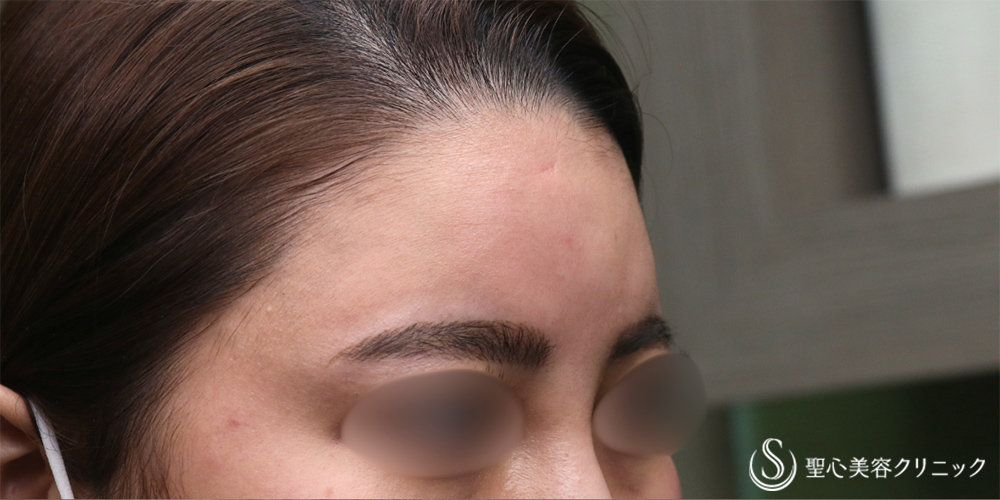 【30代女性・丸みのある額へ】プレミアムPRP皮膚再生療法（額）（2年6ヶ月後） Before 