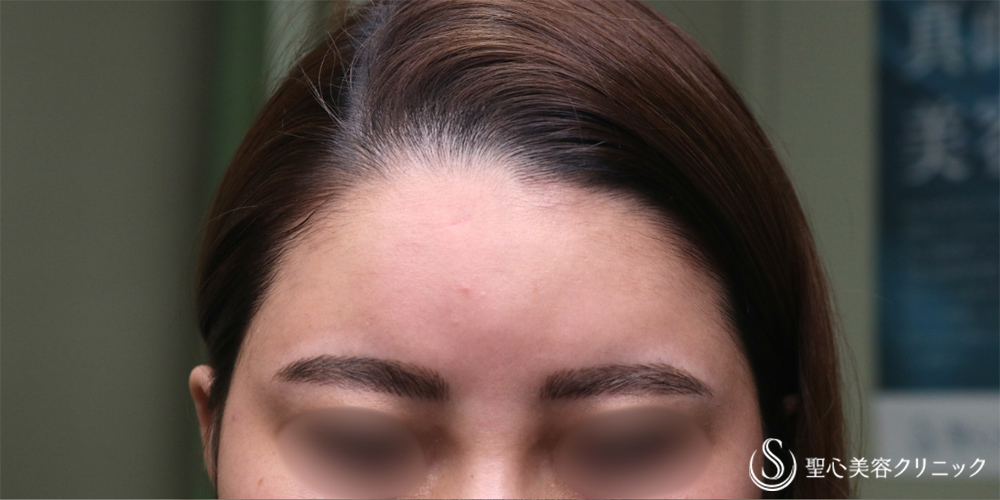 【30代女性・丸みのある額へ】プレミアムPRP皮膚再生療法（額）（2年6ヶ月後） Before 
