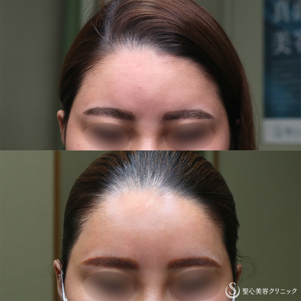 【30代女性・丸みのある額へ】プレミアムPRP皮膚再生療法（額）（2年6ヶ月後） After 名古屋院
