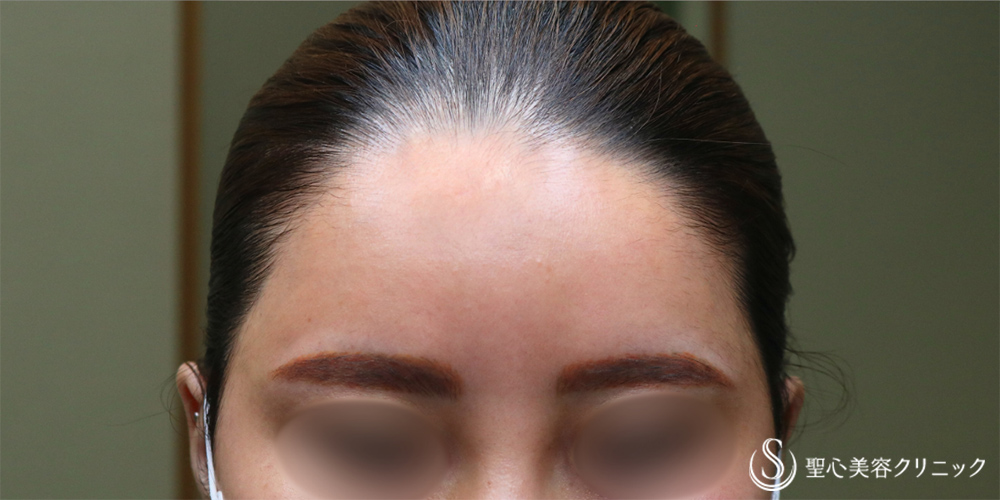 【30代女性・丸みのある額へ】プレミアムPRP皮膚再生療法（額）（2年6ヶ月後） After 