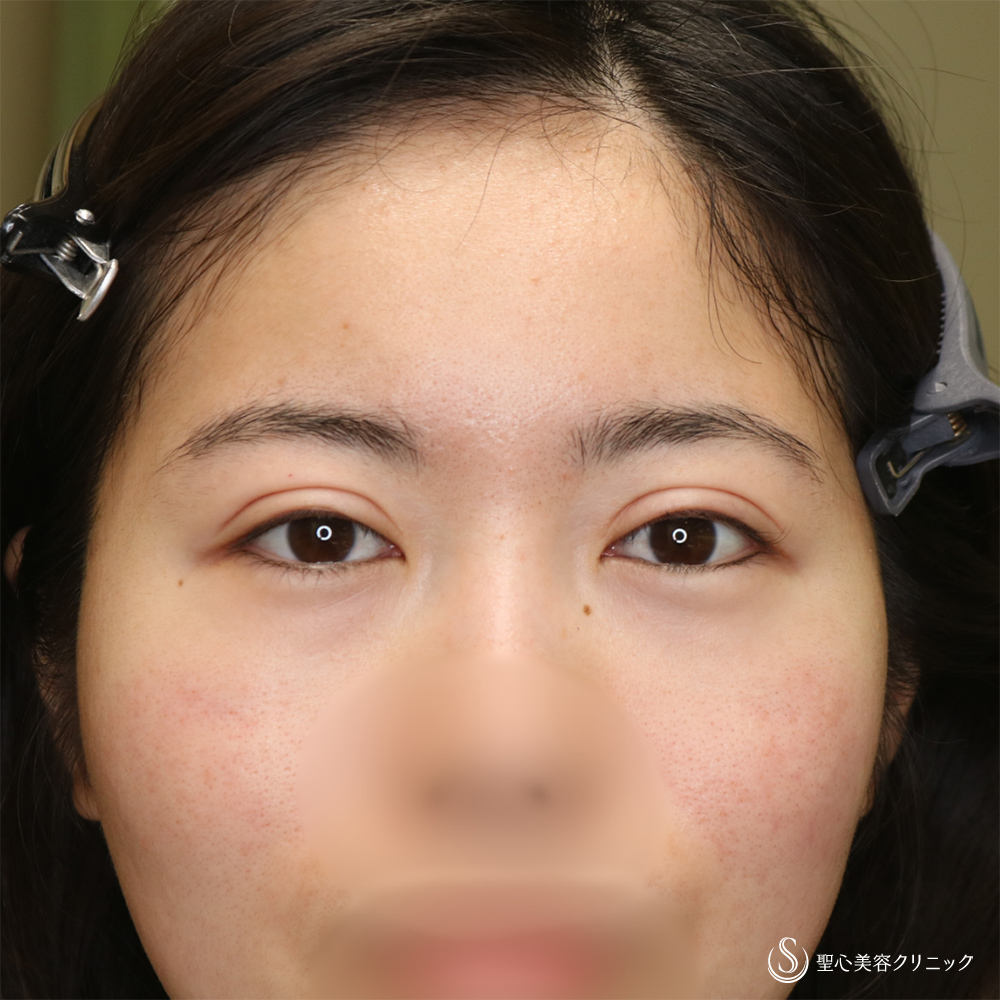 【30代女性・ハム目を解消】睫毛上皮膚切除（1ヶ月後） Before 