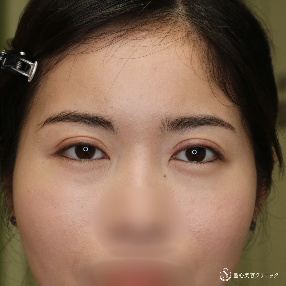 【30代女性・ハム目を解消】睫毛上皮膚切除（1ヶ月後） After 