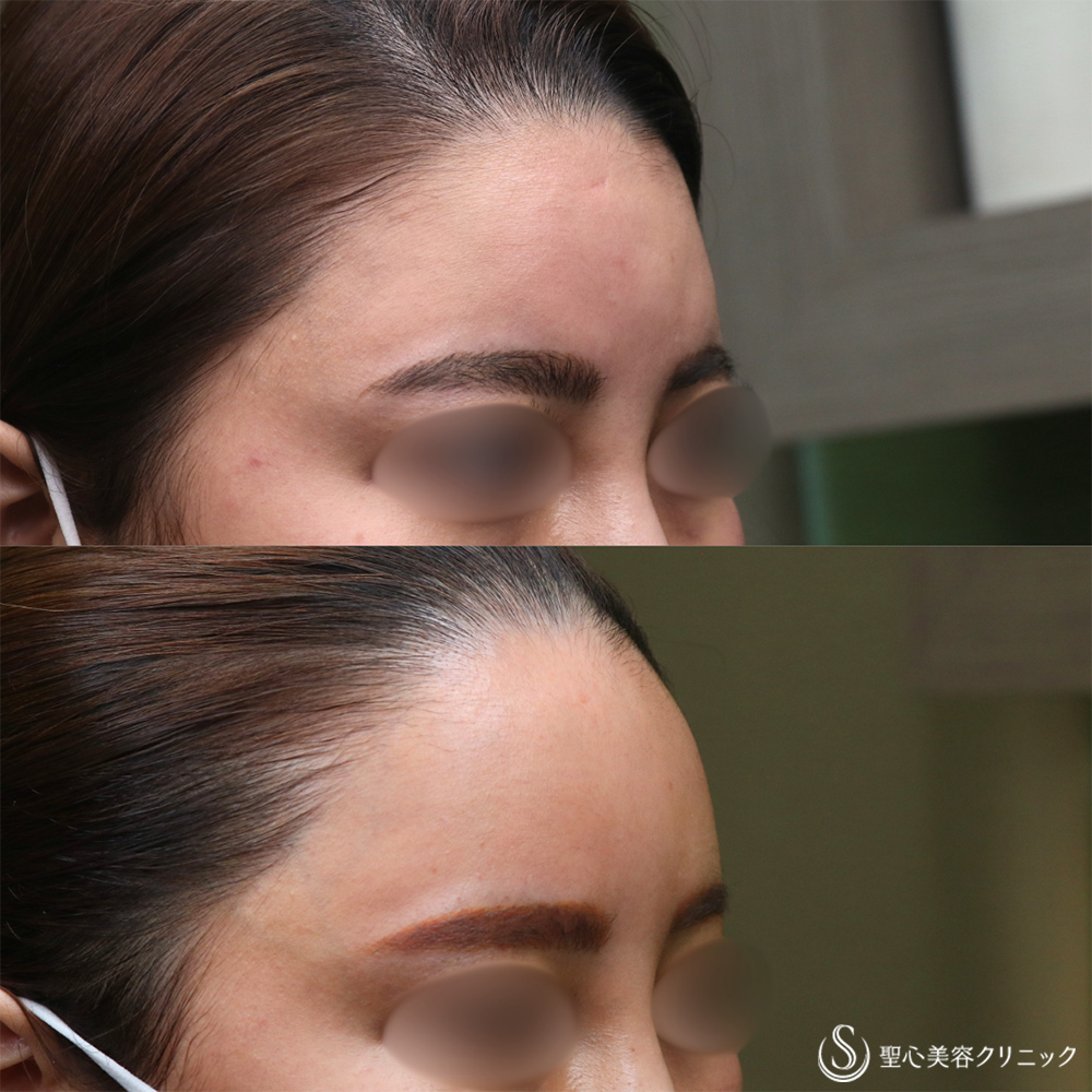 【30代女性・丸みのある額へ】プレミアムPRP皮膚再生療法（額）（2年6ヶ月後） After 名古屋院