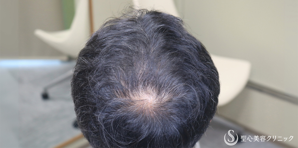【50代男性・太くハリのある毛髪へ】プレミアムグロースファクター再生療法（12回）＋デュタステリドAV＋ノキシジル（1年後） After 
