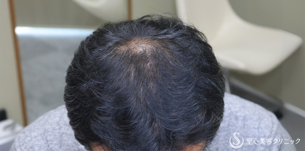 【50代男性・太くハリのある毛髪へ】プレミアムグロースファクター再生療法（12回）＋デュタステリドAV＋ノキシジル（1年後） After 