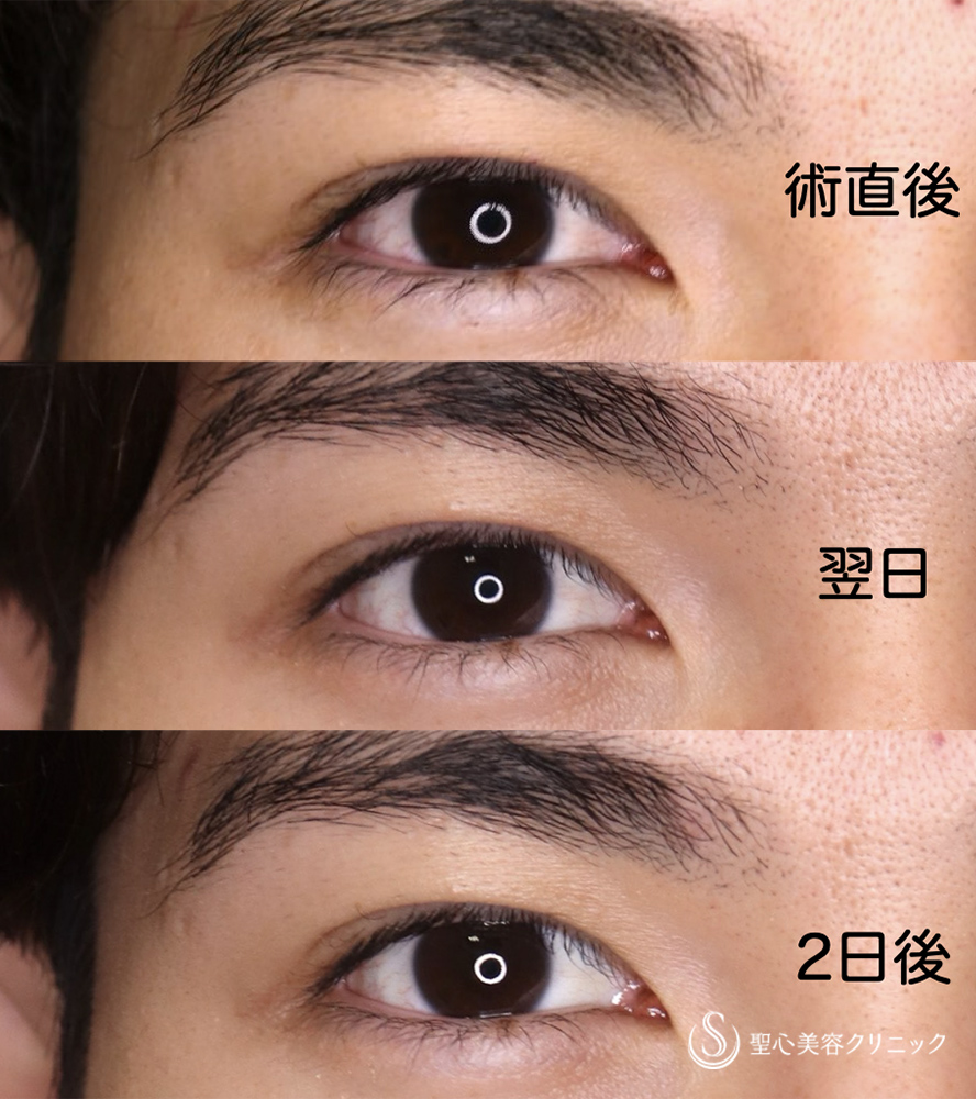【20代男性・誰からも好かれる「格好良さ」を引き出す】マイクロメソッド+α(二重埋没法)(1週間後) After