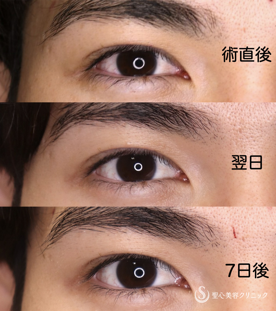 【20代男性・誰からも好かれる「格好良さ」を引き出す】マイクロメソッド+α(二重埋没法)(1週間後) After