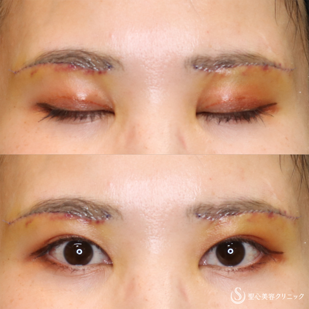 【30代女性・すっきりした二重へ】眉下切開法（眉下リフト）（3日～10日後） After 名古屋院・ダウンタイム・眉下リフト