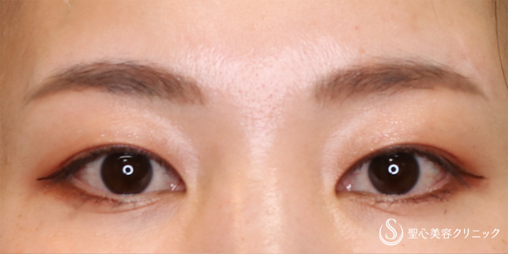 【30代女性・すっきりした二重へ】眉下切開法（眉下リフト）（3日～10日後） Before 