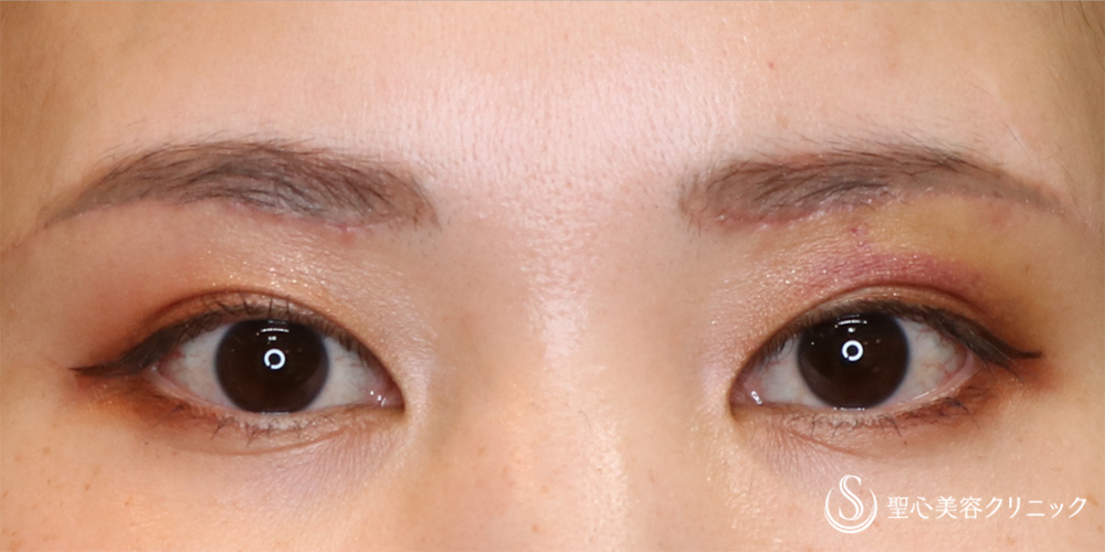 【30代女性・すっきりした二重へ】眉下切開法（眉下リフト）（3日～10日後） After 